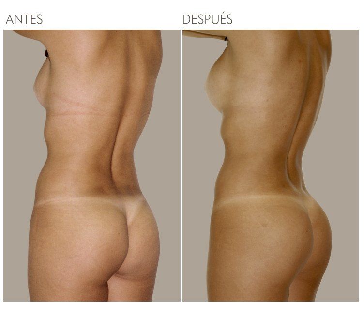 LIPOESCULTURA