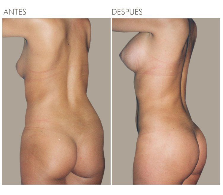 LIPOESCULTURA