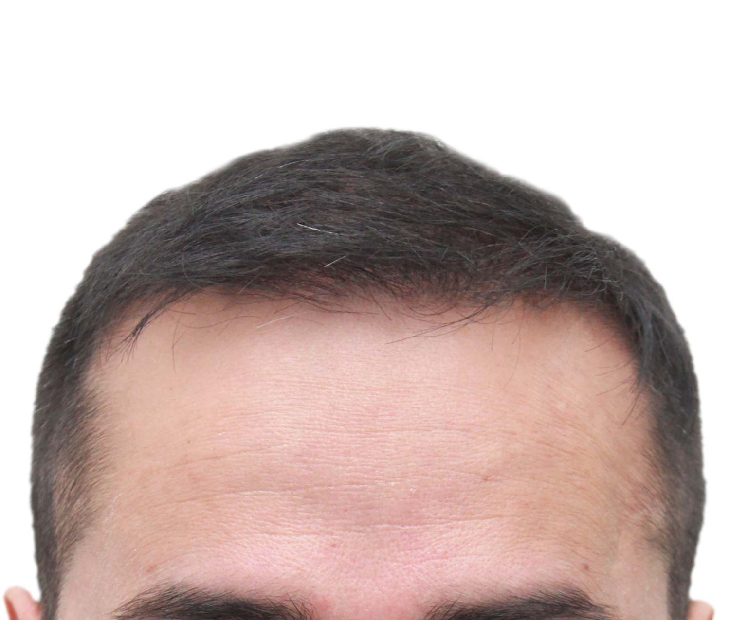 A close up of a man 's forehead with a white background