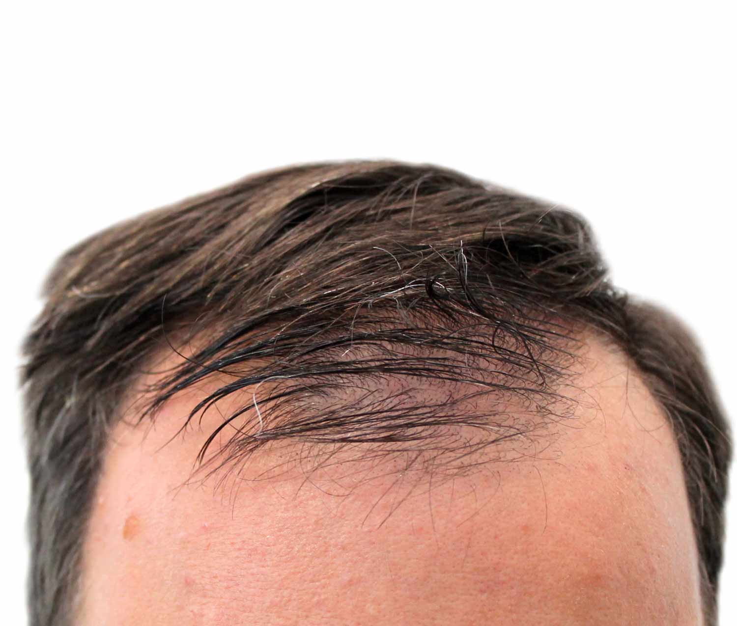 A close up of a man 's head with a bald spot on it.