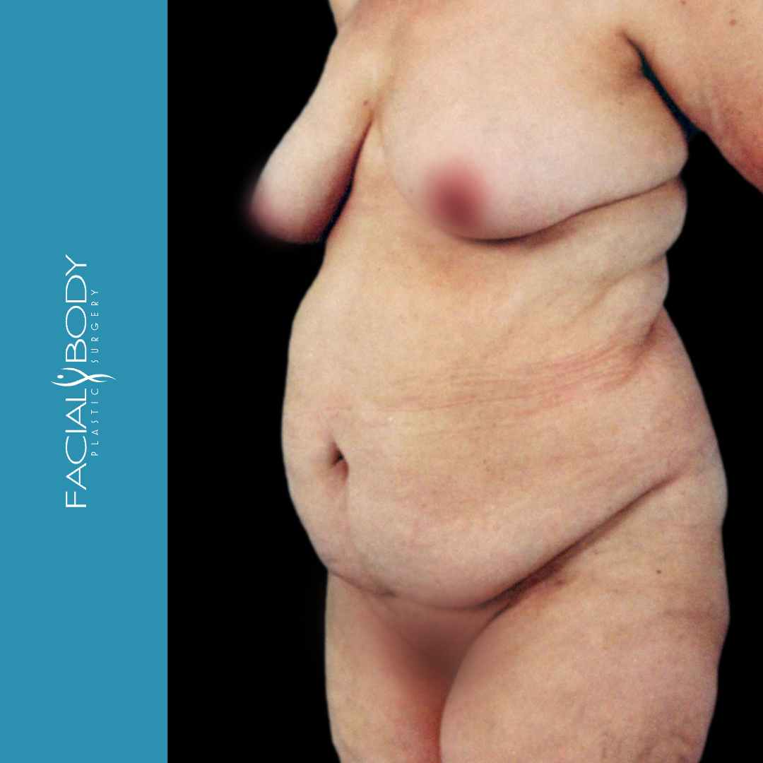 ABDOMINOPLASTIA