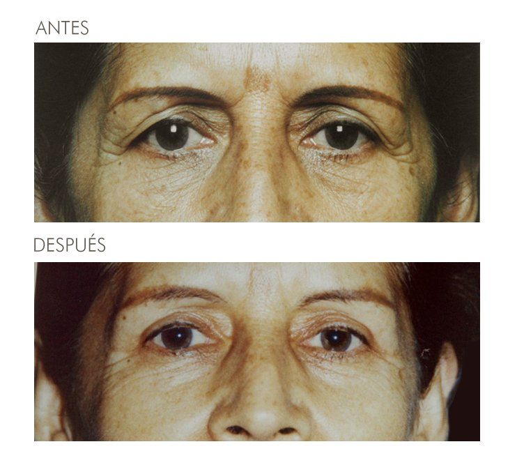 A before and after photo of a woman 's eyes