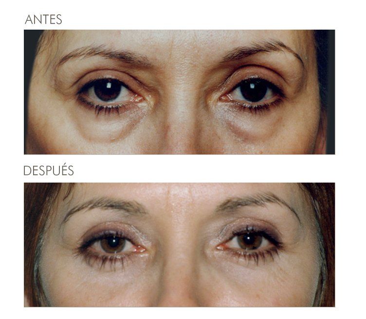 A before and after photo of a woman 's eyes in spanish