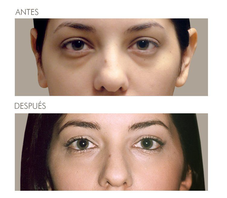 A before and after photo of a woman 's face