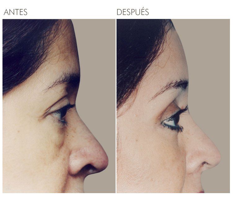 A before and after photo of a woman 's face