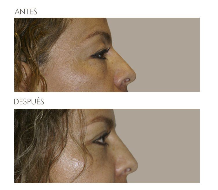 A before and after picture of a woman 's nose