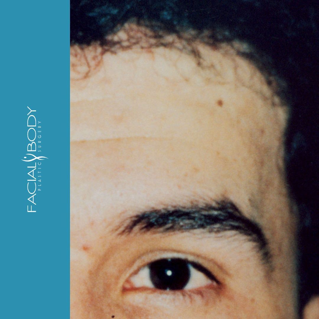 A close up of a man 's forehead with facial body written on the bottom