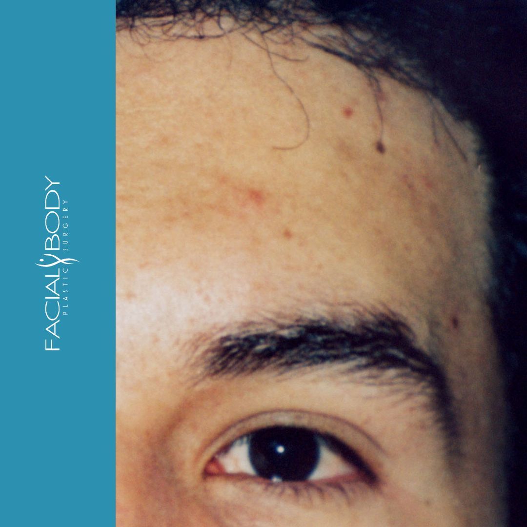 A close up of a man 's forehead with facial body written on the bottom