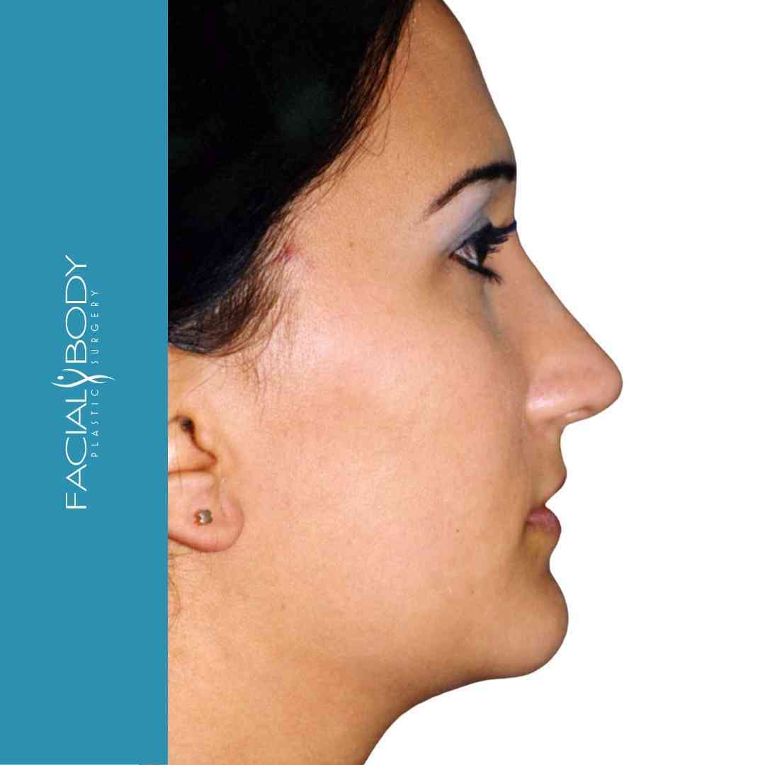 Rinoplastia-despues