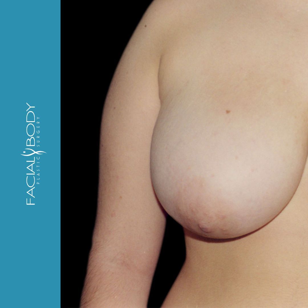 MAMOPLASTIA DE REDUCCIÓN
