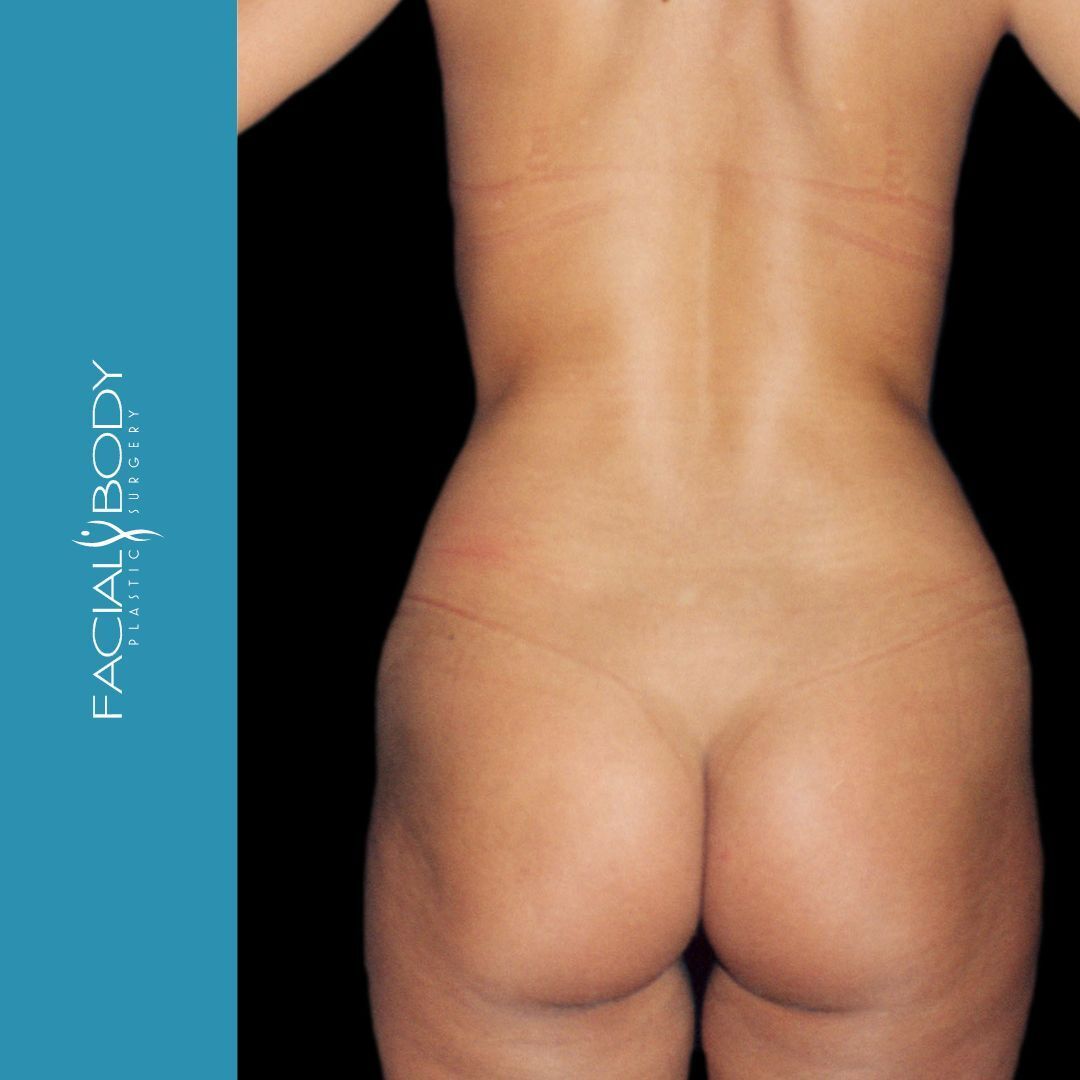 LIPOESCULTURA