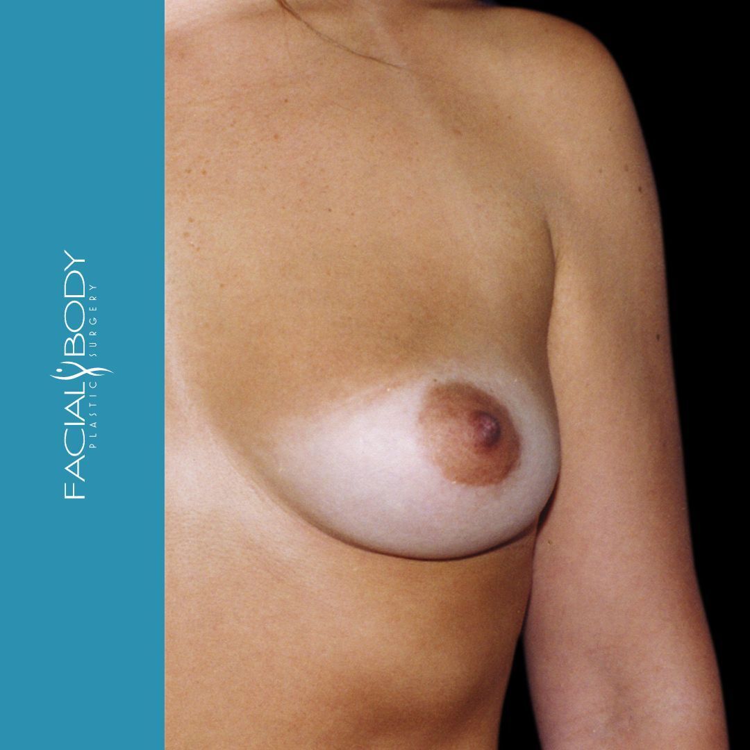 MAMOPLASTIA DE AUMENTO