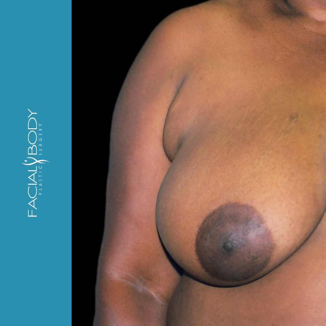 MAMOPLASTIA DE REDUCCIÓN