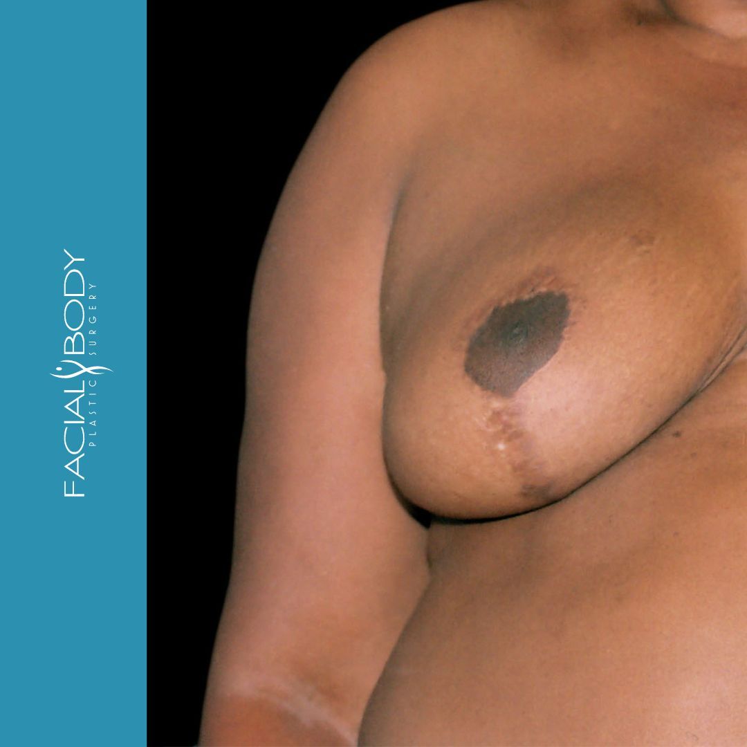 MAMOPLASTIA DE REDUCCIÓN