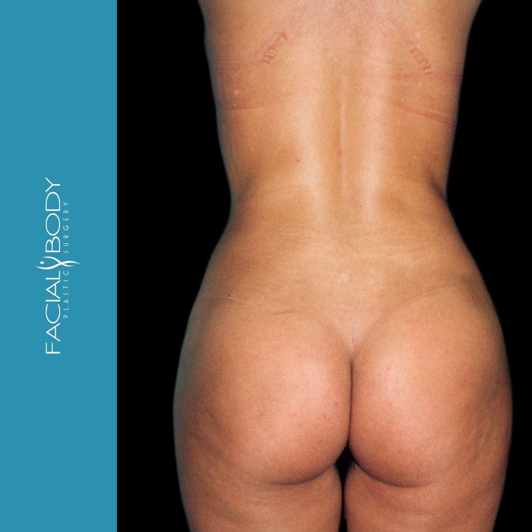 LIPOESCULTURA