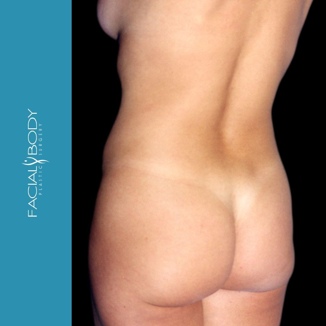 LIPOESCULTURA