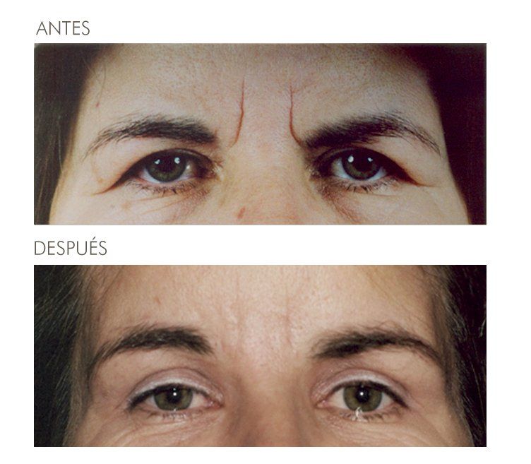 A before and after photo of a woman 's forehead