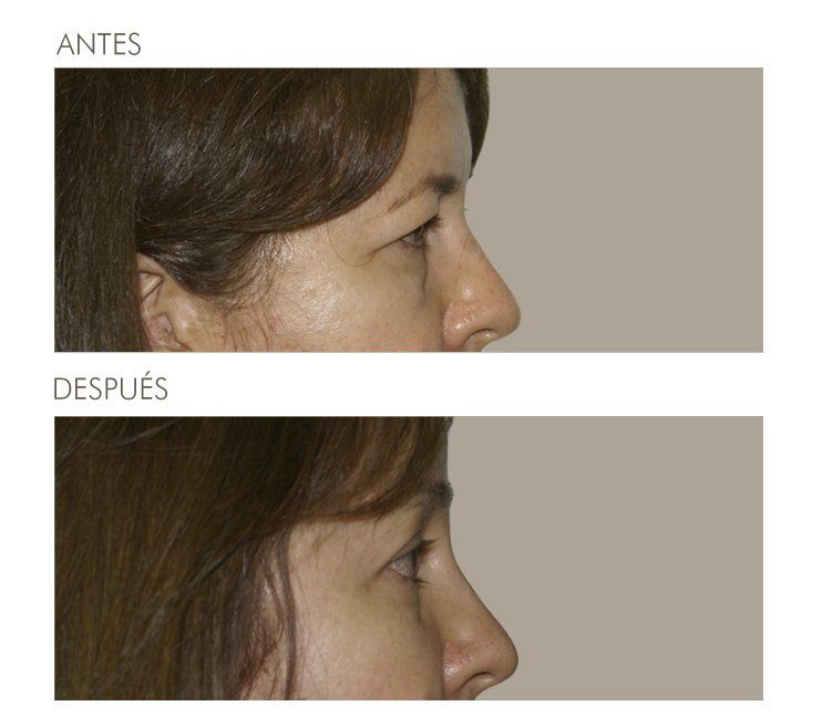 A before and after photo of a woman 's face
