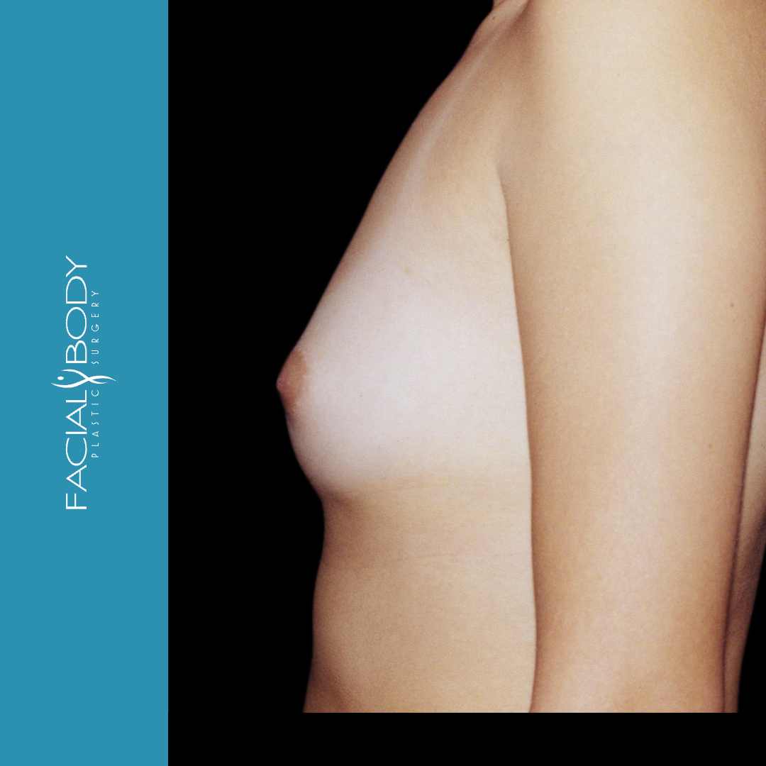 MAMOPLASTIA DE AUMENTO