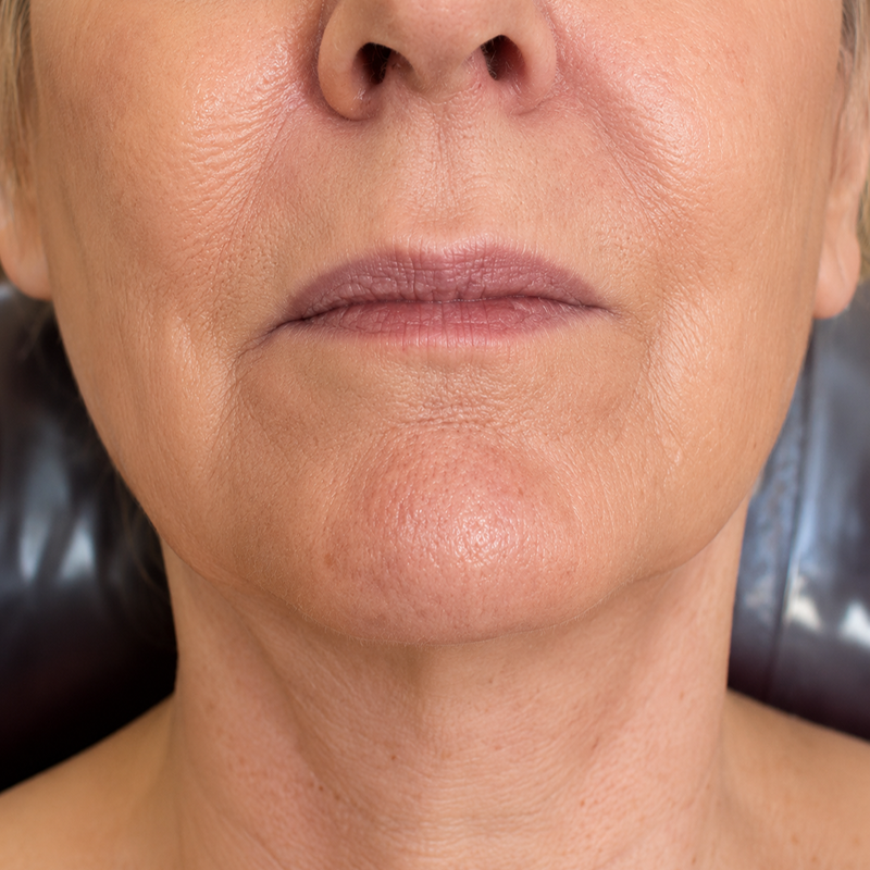 Close-up of a lower face and neck with natural skin texture and neutral expression