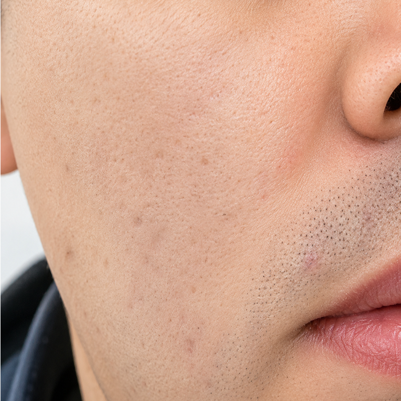 Close-up of a person’s cheek and mouth with visible stubble and a nose piercing