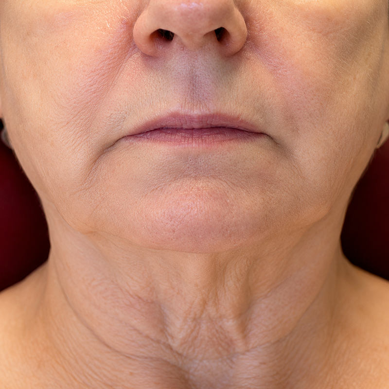 Close-up of a neutral face showing the lower nose, mouth, chin, and neck against a red background
