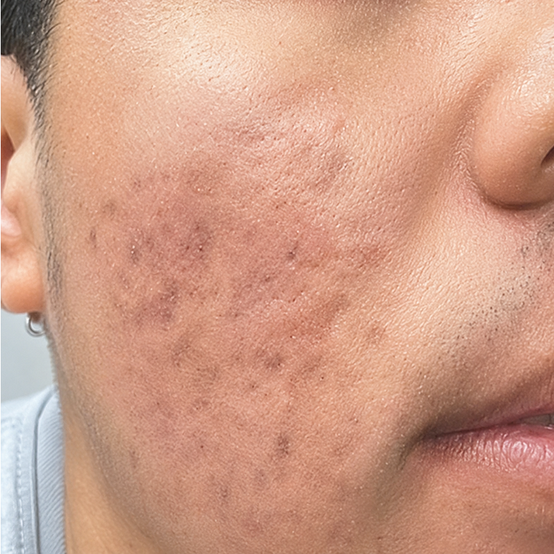 Close-up of a cheek with dark acne marks and skin blemishes