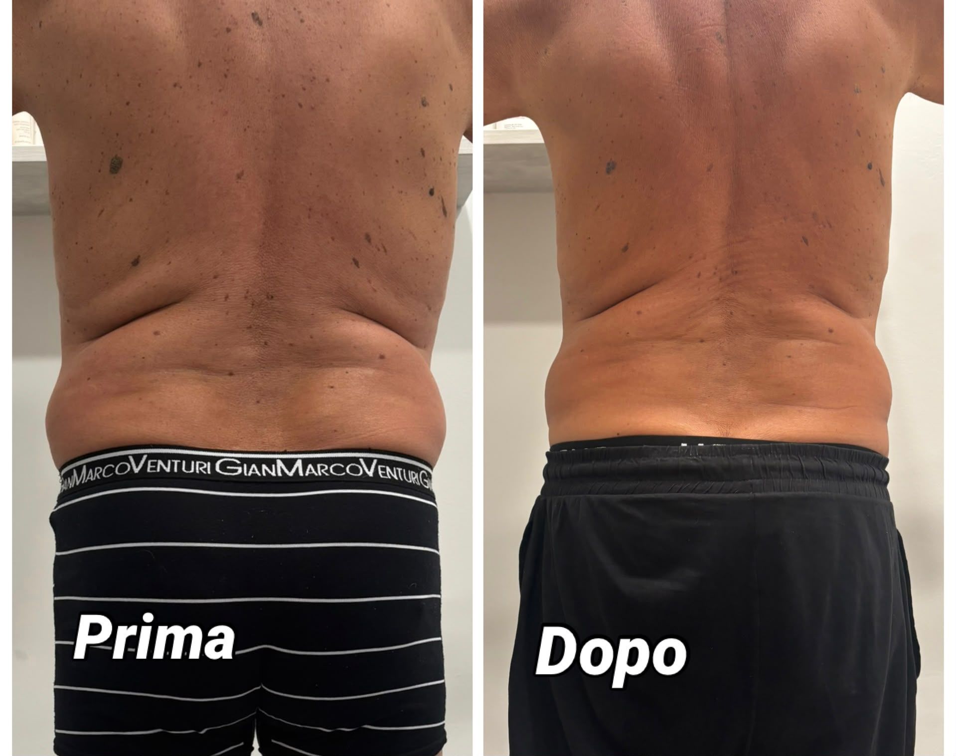 Confronto della vista posteriore del torso prima e dopo, con le etichette «Prima» e «Dopo»
