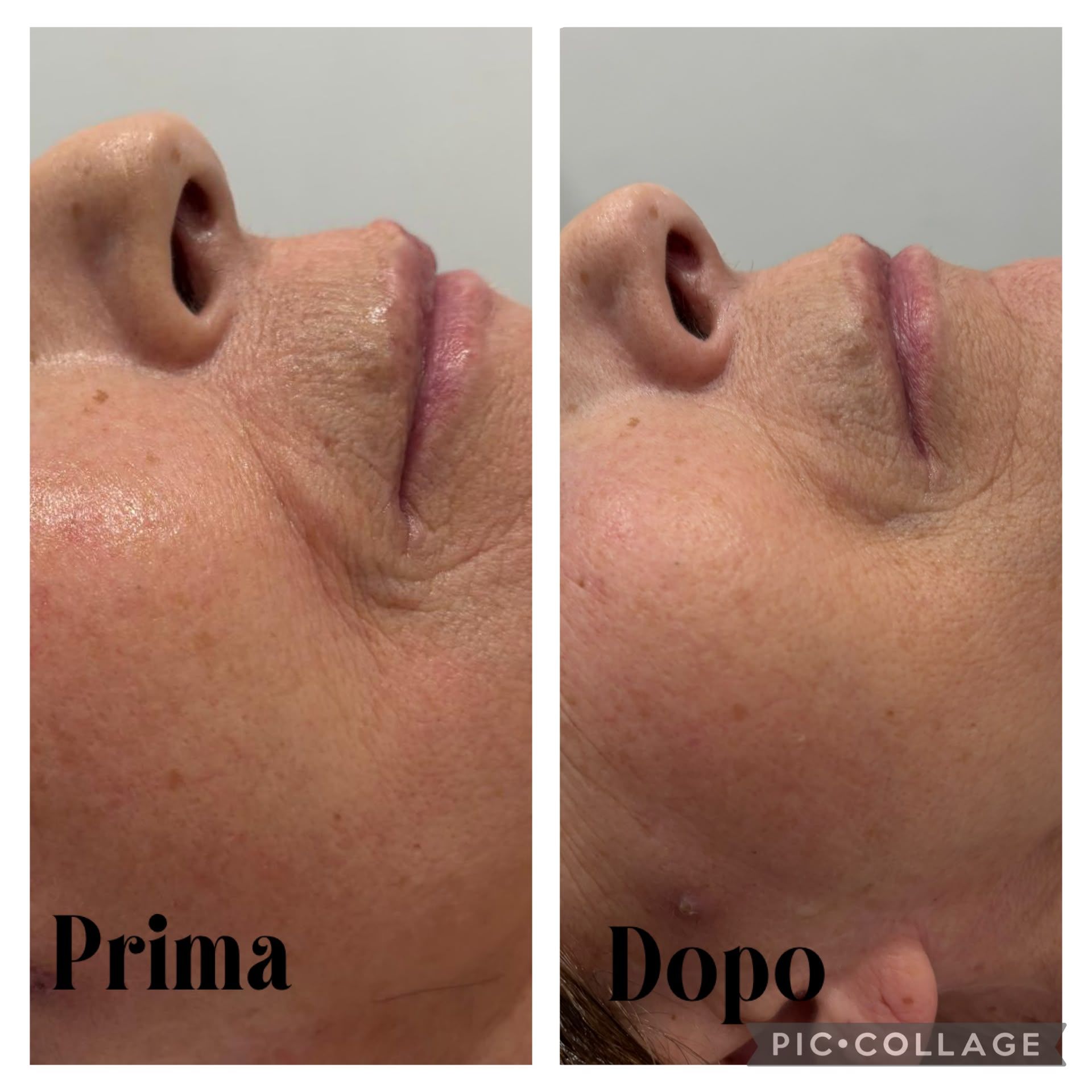 Primo piano affiancato di un profilo del viso con le etichette “Prima” e “Dopo”, che mostra i cambiamenti alle labbra e alla pelle.