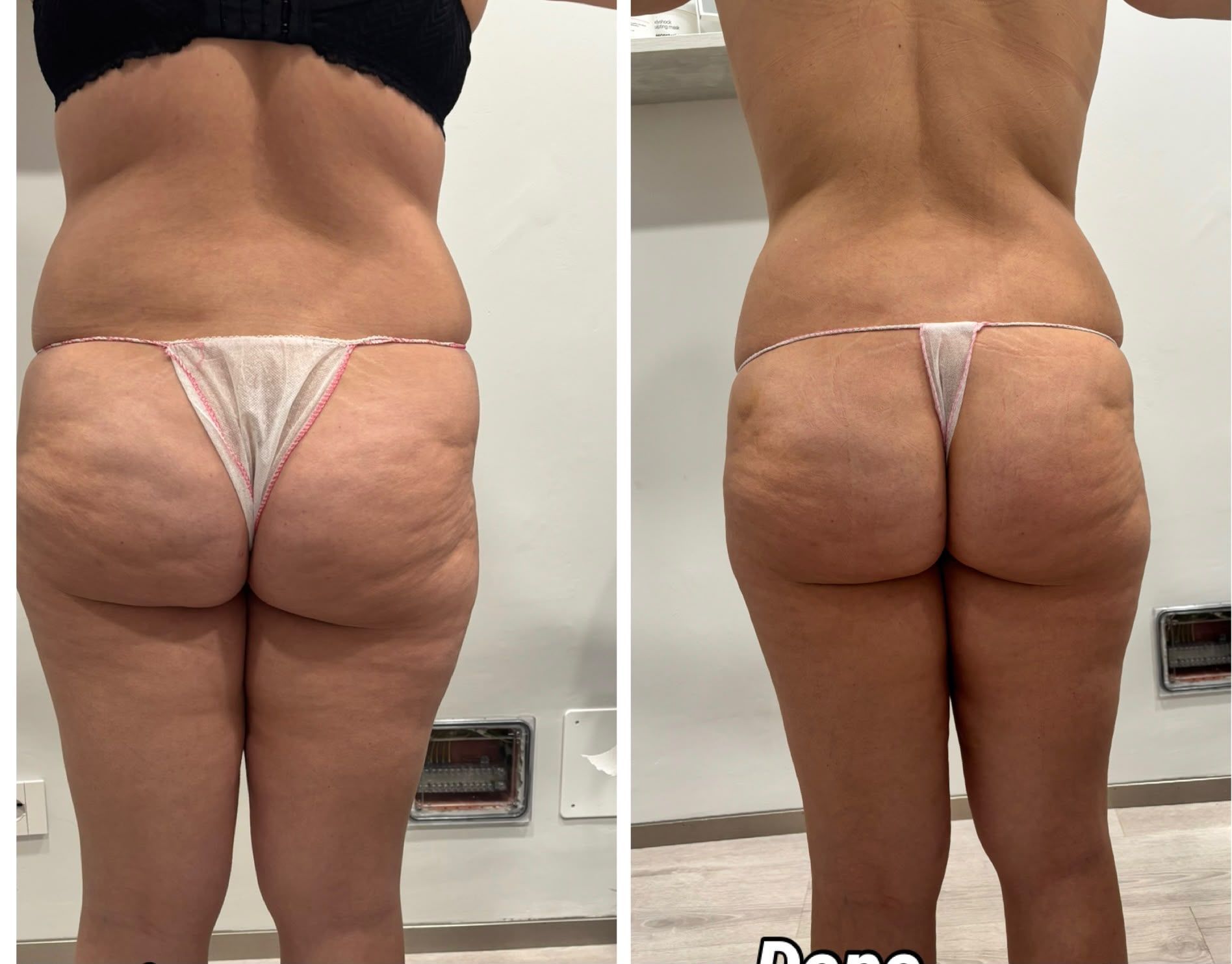 Vista posteriore affiancata di una persona in perizoma, che mostra il confronto della forma del corpo prima e dopo.