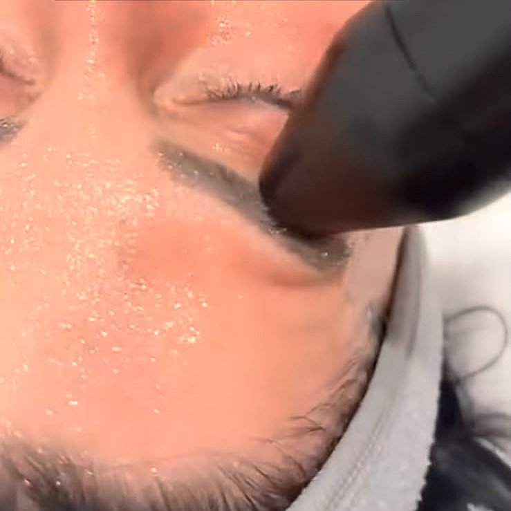 Primo piano di un dispositivo per trattamenti viso a contatto con la zona della palpebra chiusa di una persona, con della crema sulla pelle