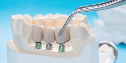 Crowns, Bridges & Implants