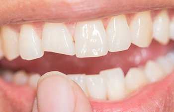 chipped tooth