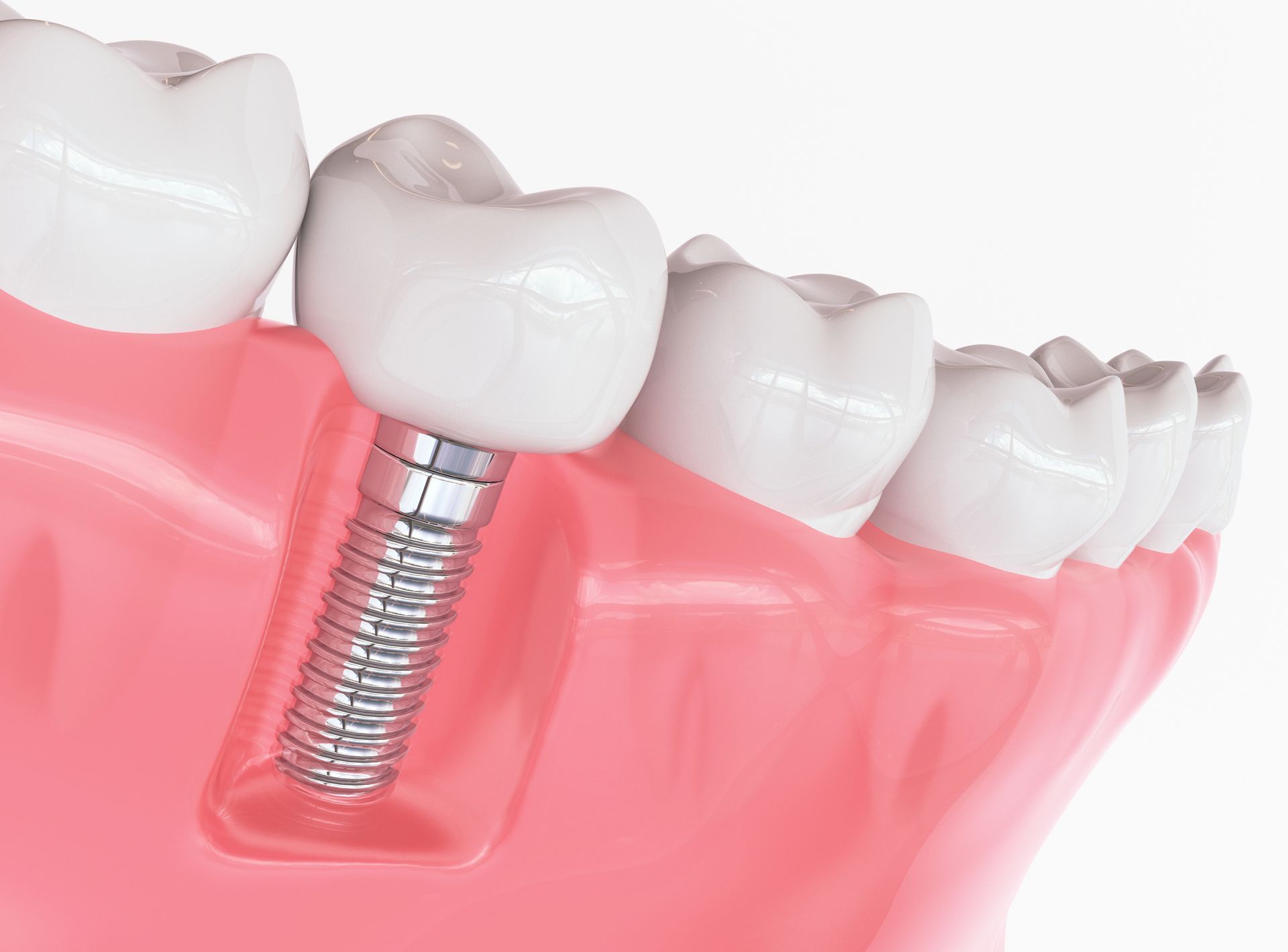 Illustrazione medica 3D di un impianto dentale, che mostra una corona fissata a un perno in titanio ancorato alla gengiva.