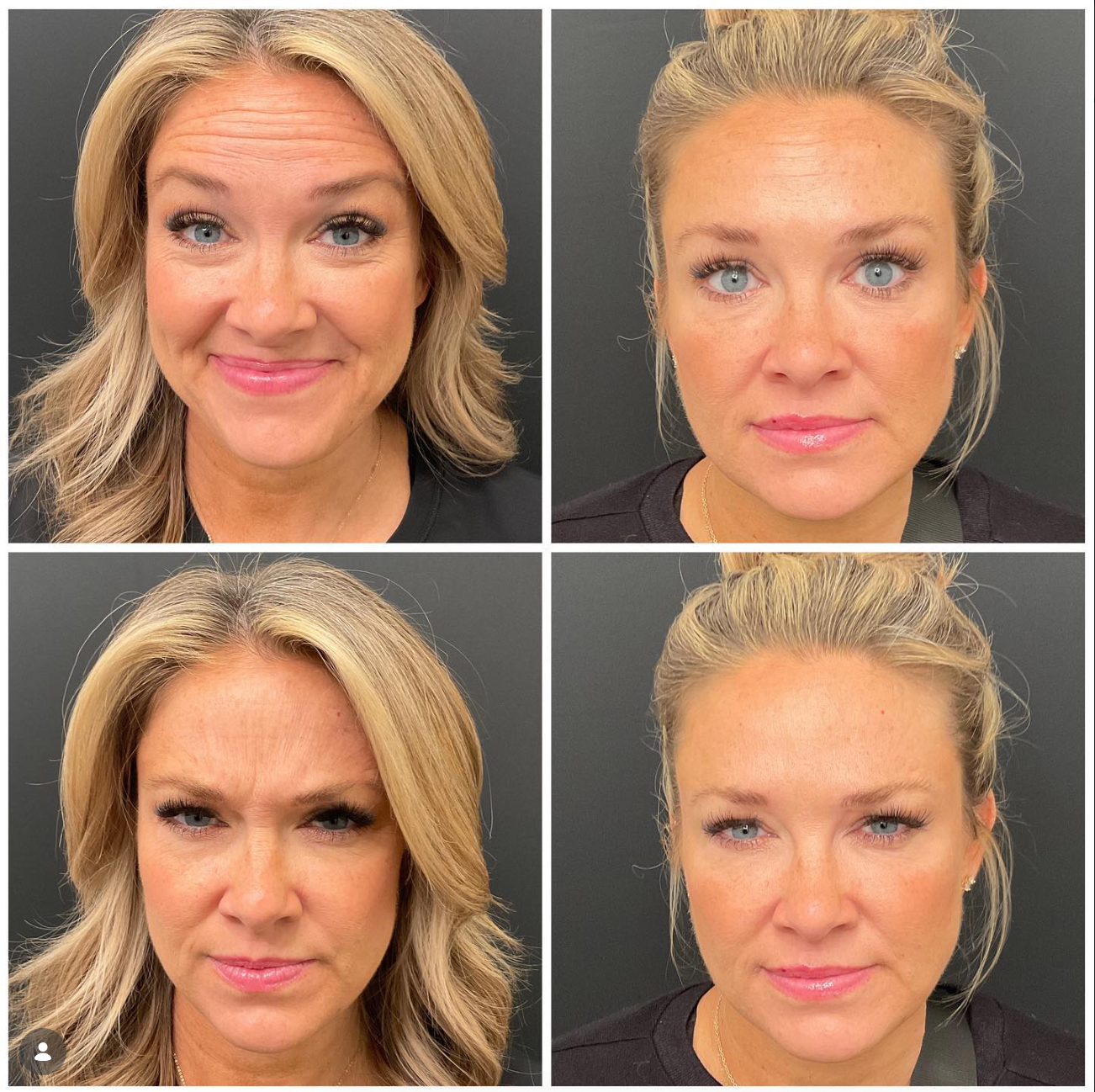 Botox & Dysport in Arvada, CO | Smooth Wrinkles Today