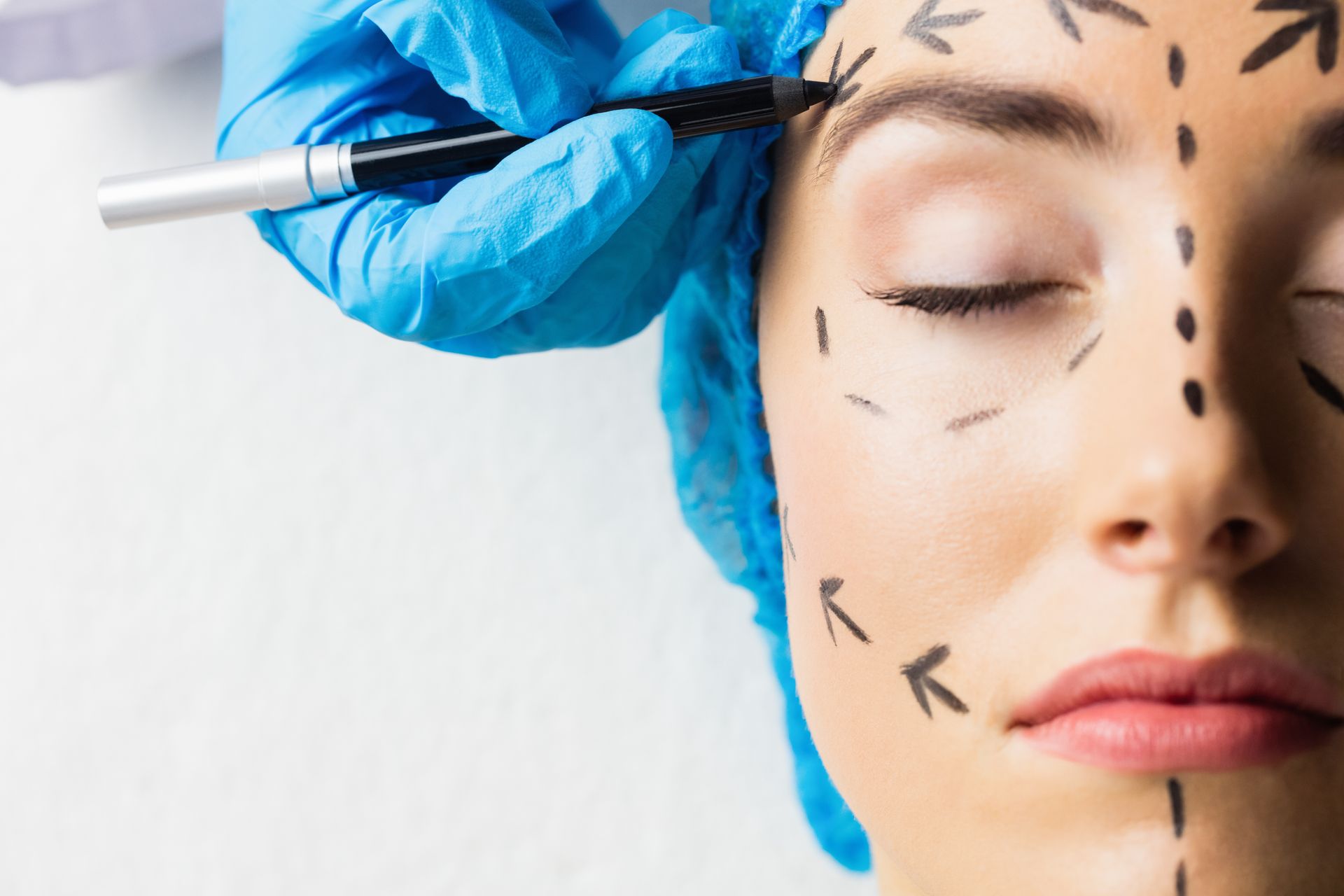 A person with surgical markings drawn on their face as a gloved hand uses a marker near their brow.