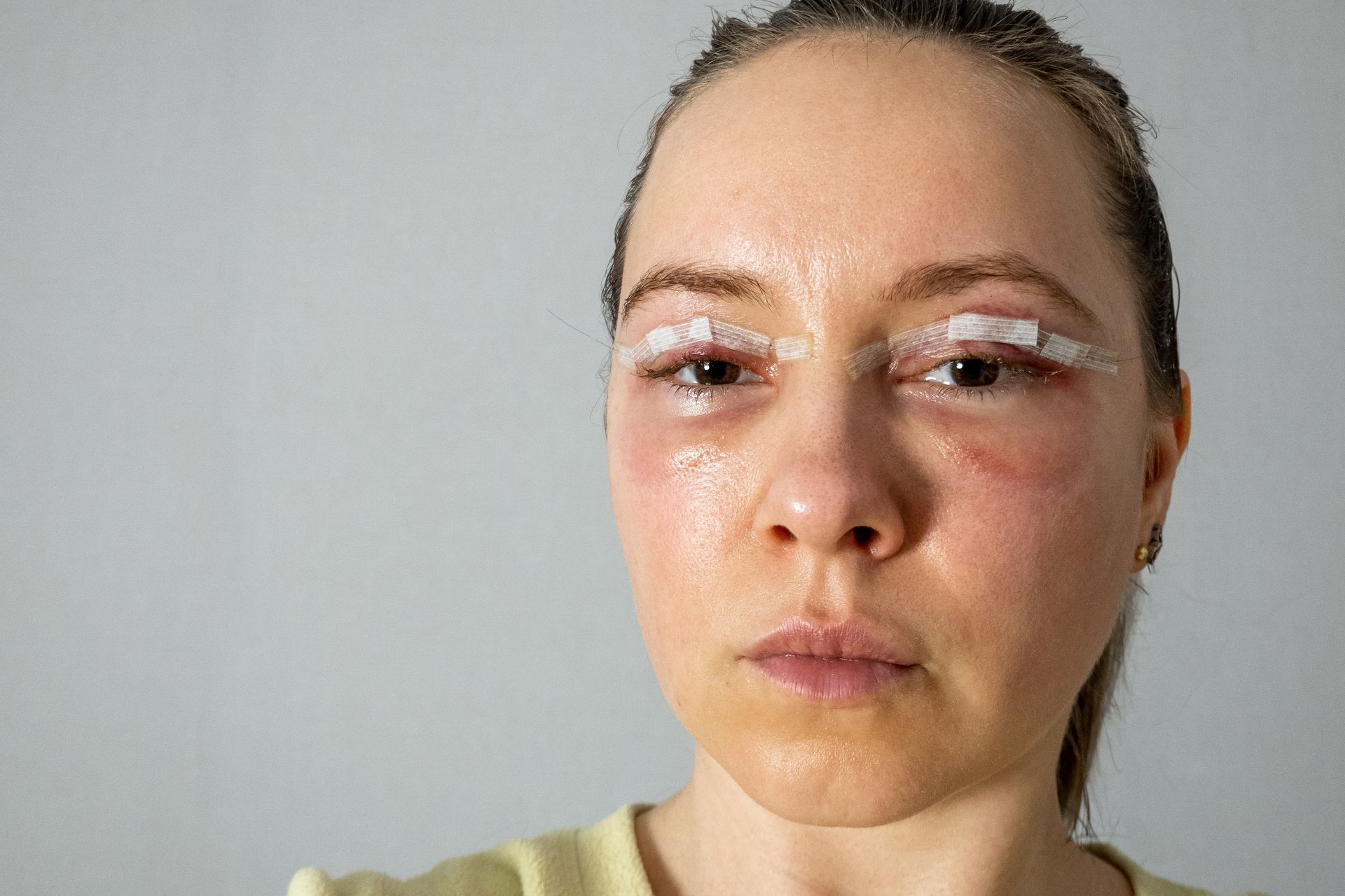 A person with surgical tape over their upper eyelids, showing post-operative bruising around the eyes.