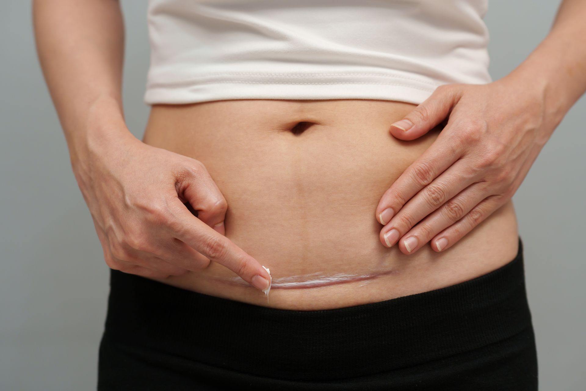 Hands measure a horizontal scar on a bare abdomen above black pants.