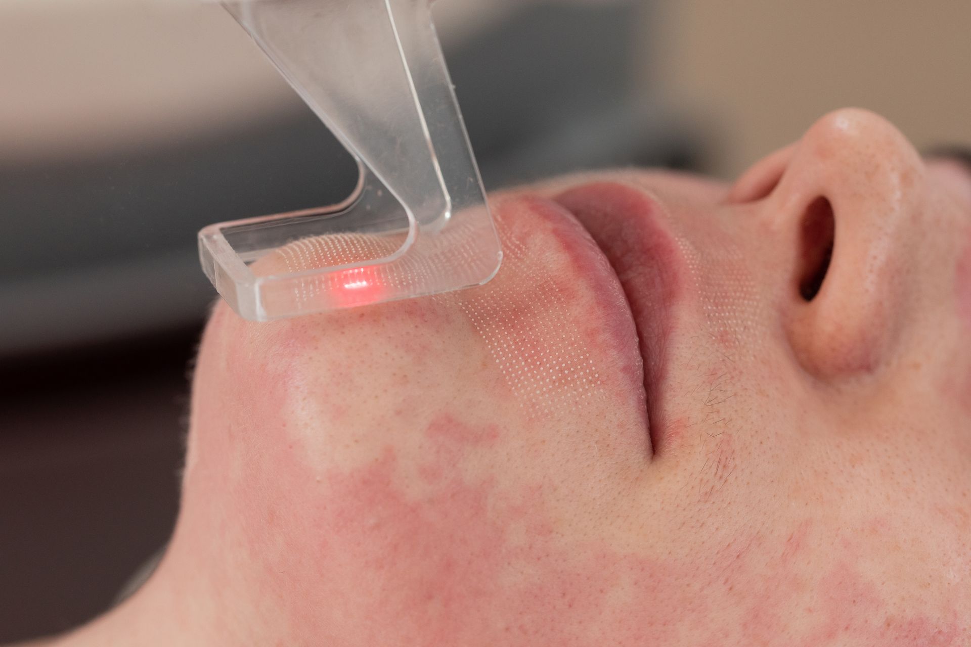 CO2 laser skin resurfacing treatment at Clearview Dermatology