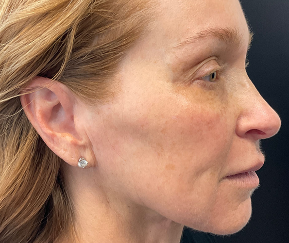 patient at clearview dermatology in arvada colorado before and after fraxel laser treatment