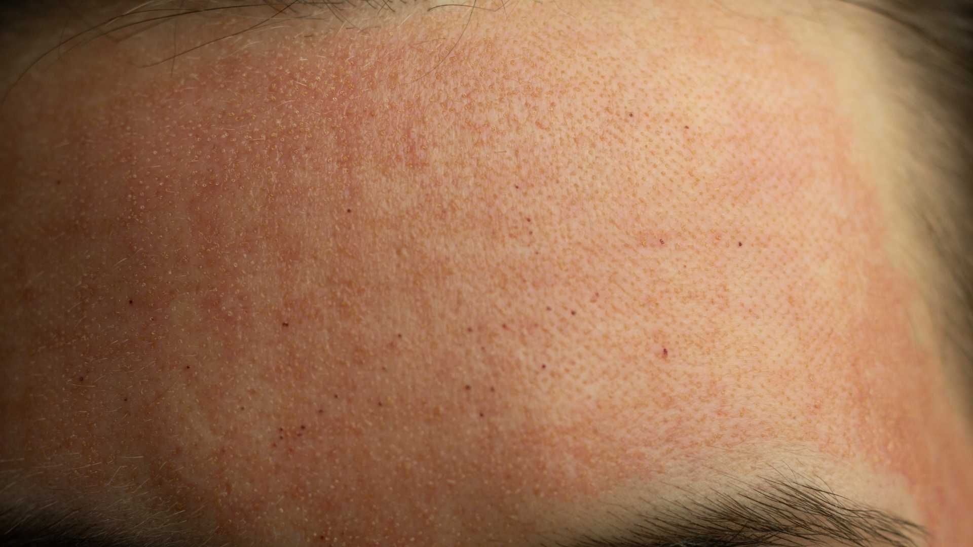 Close-up of a forehead with small dark freckles and a faint hairline visible at the bottom.