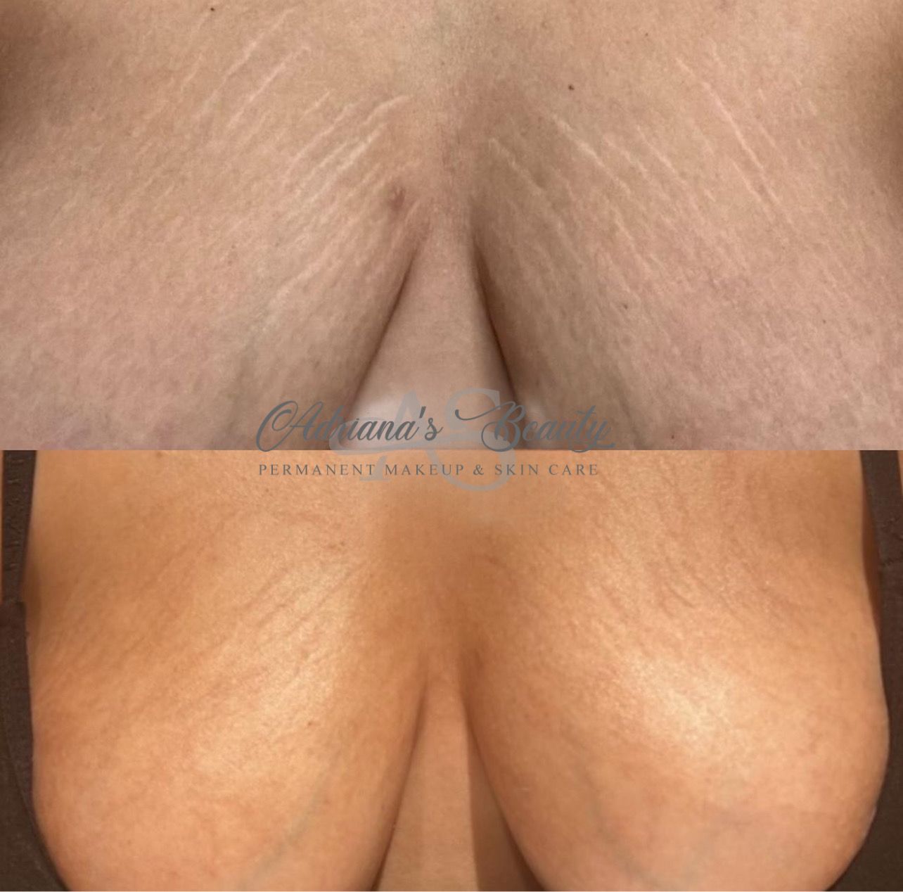 Comparison of skin before and after stretch mark treatment on breasts.