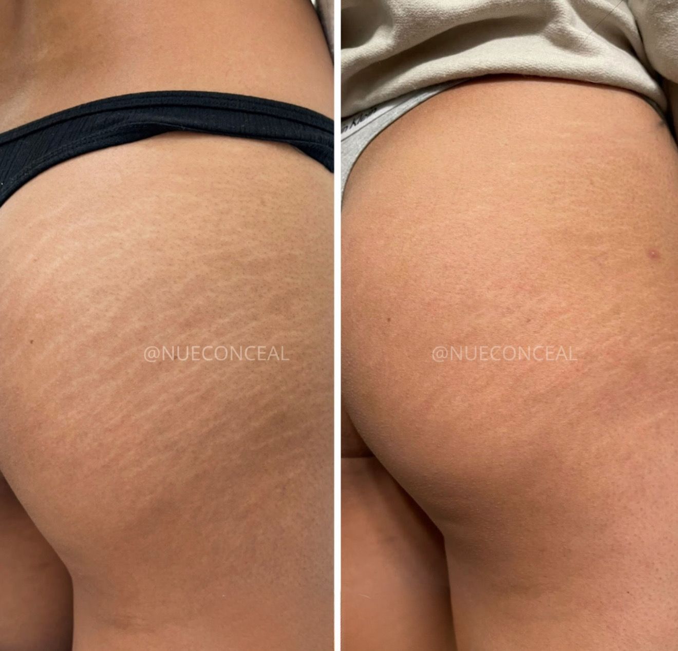 Before and after shots of a person's buttock, showing reduction of stretch marks.