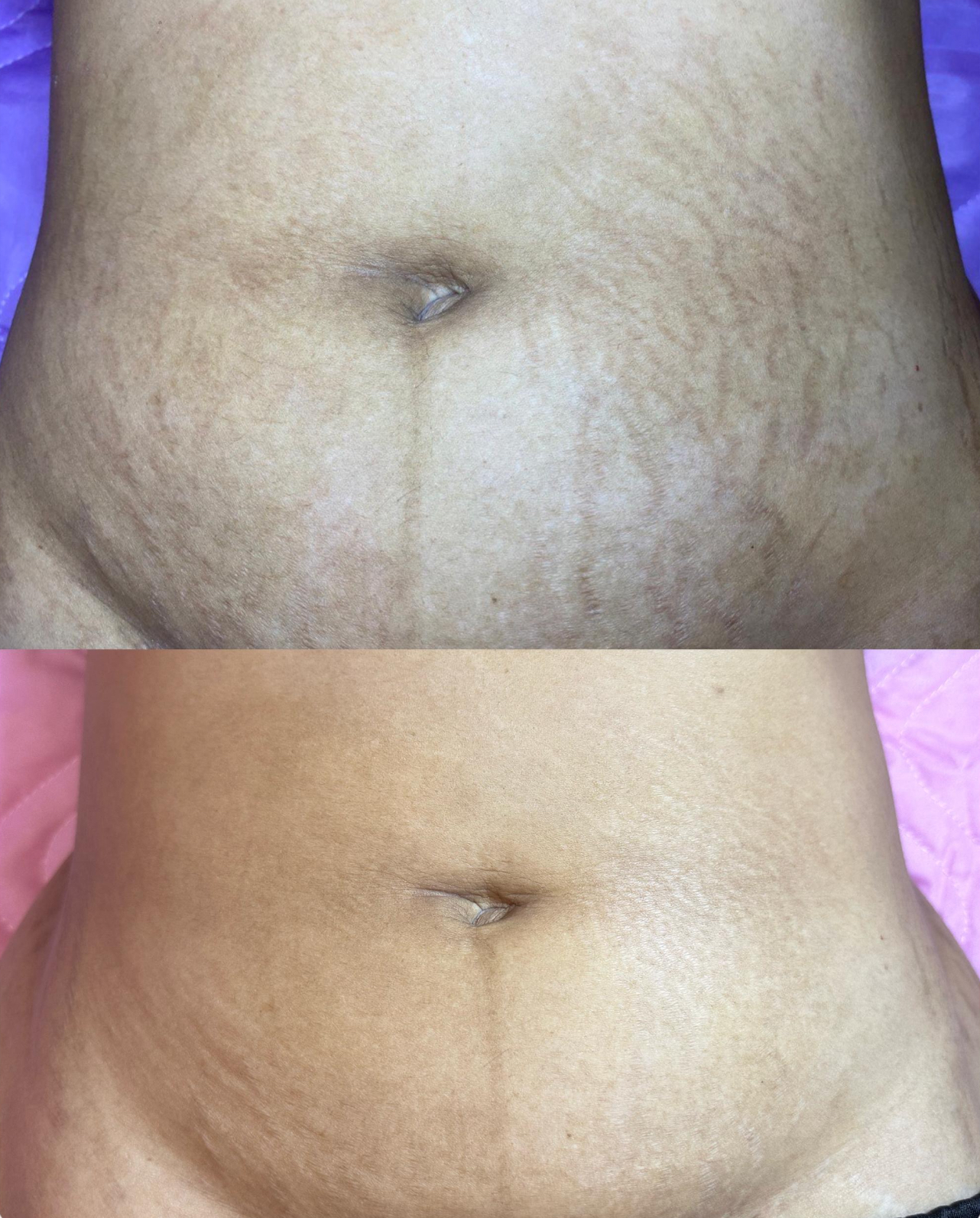 Before and after view of a person's stomach with stretch marks, then the skin appears smoother.