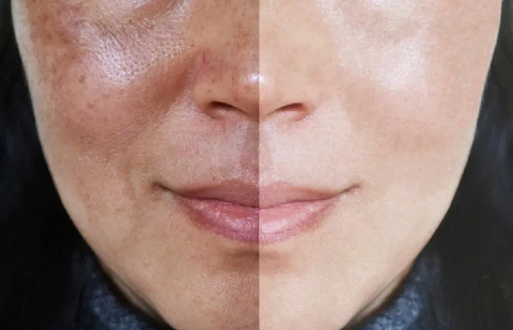 Half face with sunspots and uneven skin tone; the other half, smooth and even-toned.