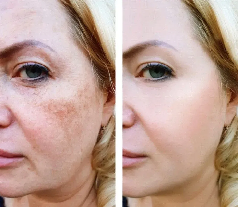 Side-by-side comparison: woman's face with hyperpigmentation and after treatment, skin appears even-toned and smooth.