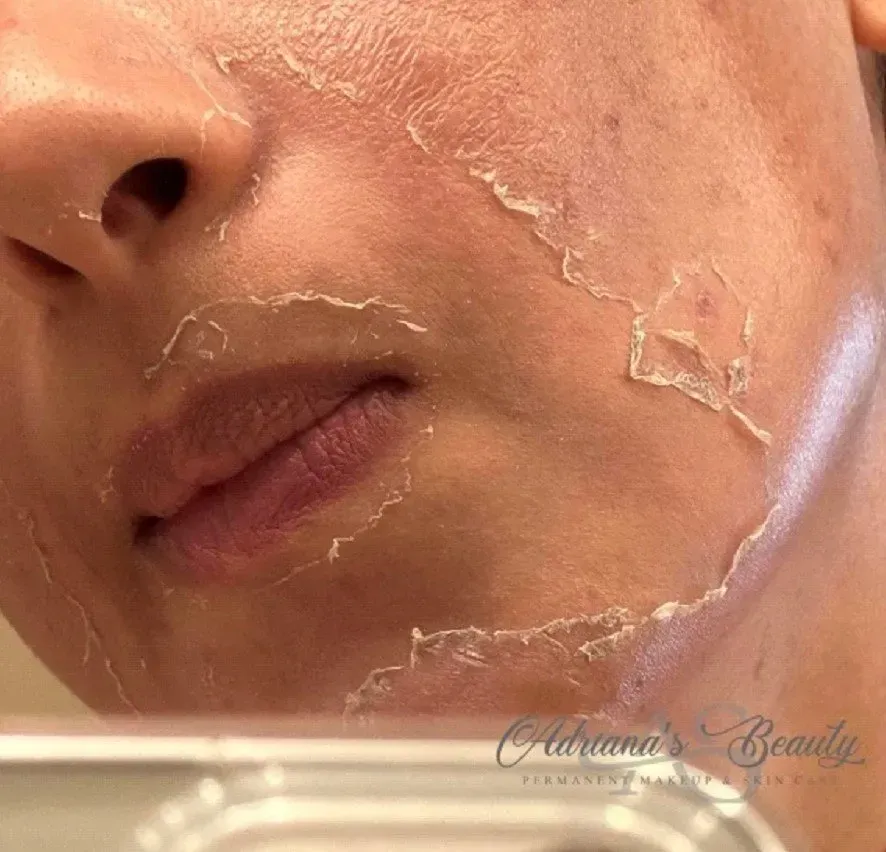 Close-up of a person's face with skin peeling after a treatment, reddish tone.