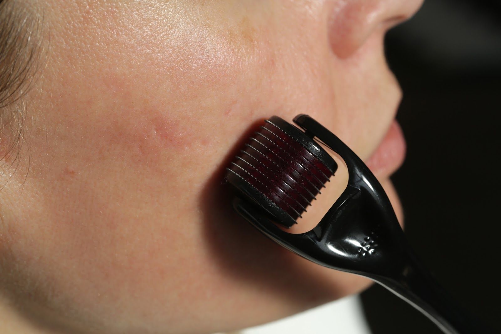 Dermaroller applying treatment to a person’s cheek close-up