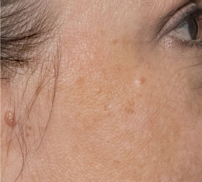 A close up of a woman 's face with clearer skin Glacial RX