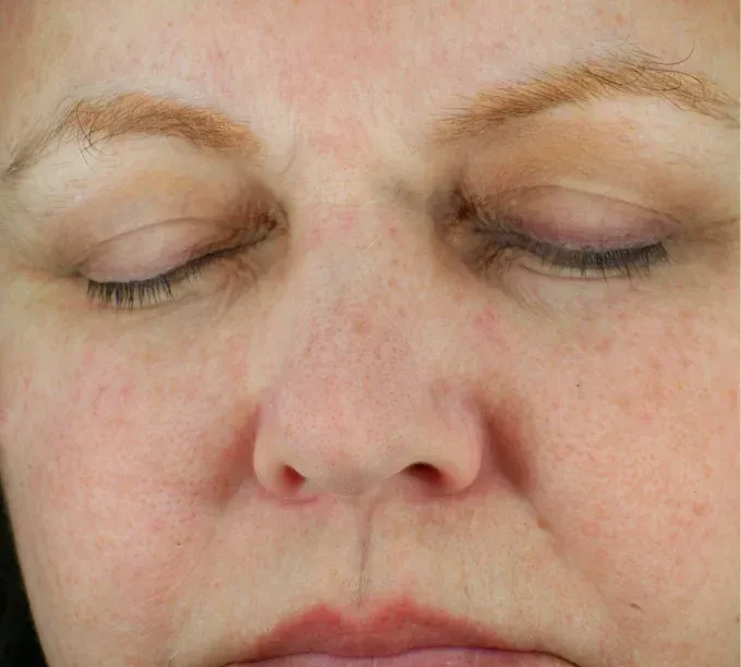 A close up of a woman 's face with her eyes closed and healthier skin after Glacial RX